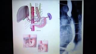 Esophagus  innervation and clinical correlates [upl. by Aiuqenehs]