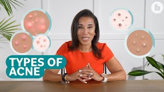 The Different Types of Acne and How to Treat Them [upl. by Auhesoj665]