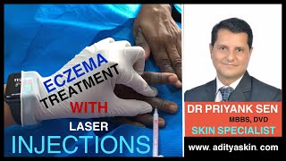 एग्जिमा का आधुनिक इलाज क्या है  What is the modern treatment of eczema by DR PRIYANK SEN  SKIN SP [upl. by Luigino]