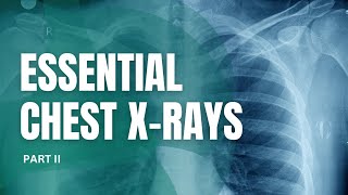 Essential Chest Xrays for Students Part II [upl. by Eitak]