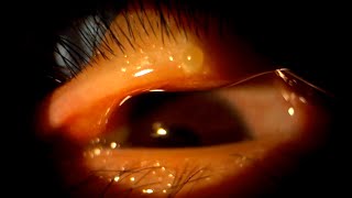 Conservative treatment of a chalazion [upl. by Notslah]