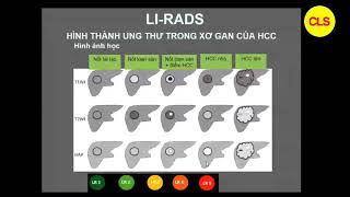 LIRADS  THS BS CKI NGUYỄN CÔNG QUỲNH [upl. by Sucramej625]