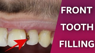 Front Teeth Filling Process  Dentist do front tooth decay repair  Composite bonding restoration [upl. by Hendrickson]