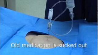 Intrathecal or Spinal Morphine pump or Baclofen pump refill procedure [upl. by Simmonds]