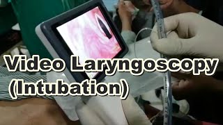 Video Laryngoscopy  Endotracheal Intubation  Laryngoscopy  General Anesthesia  Bougie Wire [upl. by Violante418]