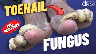 Cutting THICK fungus TOENAILS [upl. by Daniele417]