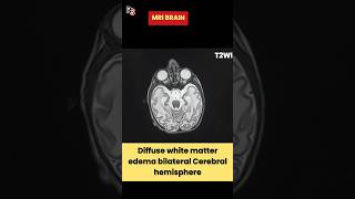 White Matter Edema ll Cerebral Edema ll Vasogenic ll Cytotoxic radiology MRIbrain anatomy shorts [upl. by Hannala]