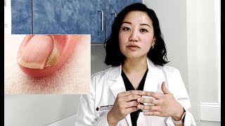 What is PARONYCHIA Its a nail infection  Solve Paronychia with Julia Ro PAC [upl. by Namor291]