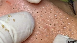 Big Cystic Acne Blackheads Extraction Blackheads amp Milia Whiteheads Removal Pimple Popping  4591 [upl. by Eralc]