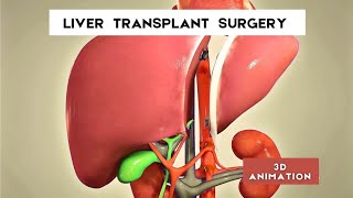 liver transplant surgery procedure  3D Animation [upl. by Dud]