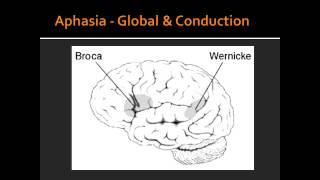 Aphasia  Global amp Conduction [upl. by Iorio]