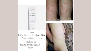 Avène Cicalfate Restorative Protective Cream used on Hand Foot Mouth Rash cleared FAST [upl. by Litsyrk]