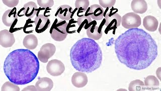 Acute Myeloid Leukemia AML w Monocytic Differentiation formerly AMML with Blasts amp Promonocytes [upl. by Berfield]