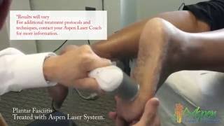 Laser Treatment of Plantar Fasciitis [upl. by Nirmak]