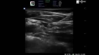 ultrasound guided supraclavicular brachial plexus block in one minute only [upl. by Belter343]