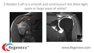 How to read your shoulder MRI with Dr Centeno of Regenexx [upl. by Aknaib]