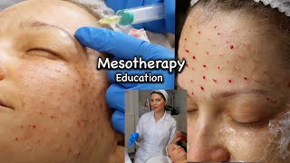 Mesotherapy for Face including around the Eyes injection technique using 13mm 30G needle [upl. by Elirpa313]