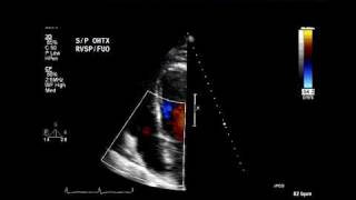 Eccentric tricuspid regurgitation jet suggests flail leaflet [upl. by Africa]