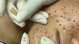 TREATMENT OF BIG BLACKHEADS AND HIDDEN ACNE IN THE FACE 536 [upl. by Ennoryt292]