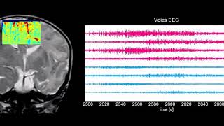 Neuroimagerie fonctionnelle par ultrasons chez le nouveauné [upl. by Yrovi]