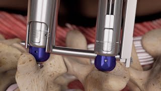 Threshold™ Pedicular Fixation System [upl. by Ahsrat]