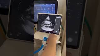 Portable Handheld Wireless Cardiac Ultrasound portableultrasound [upl. by Nirred]