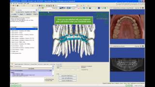 SureSmile QT Lingual Treatment  part 8 [upl. by Medrek]