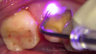 Gingival troughing with SiroLaser Blue before CEREC Digital [upl. by Waylan]