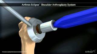 Arthrex Arthrex ECLIPSE™ Shoulder Arthroplasty System [upl. by Esylle]