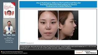 Use of Autologous AdiposeDerived Stromal Vascular Fractions in Revision Rhinoplasty for Severe [upl. by Eelsha]