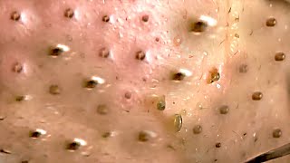 Amazing Blackheads Remover on the Face 019 [upl. by Oruam]