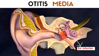 Otitis Media  Ear Infection [upl. by Laband]