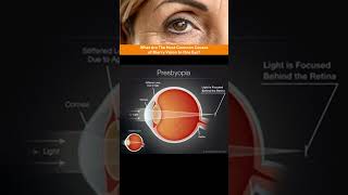 Presbyopia  Defect Of Vision  HUman eye and colorful world shorts physics [upl. by Alden]