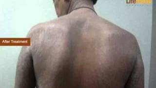 Treatment for Extensive Psoriasis on Whole Body [upl. by Hoo]