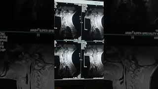 HOW TO DO MRI CERVICAL SPINE 🤷 EXPLAIN SEQUENCE cervical spine mriscanradiologytrendingshorts [upl. by Eb]