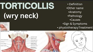 Torticollis wry neckDefinition Other nameAnatomyPathology CausesSignampSymptomsPhysiotherapy [upl. by Anitnemelc]