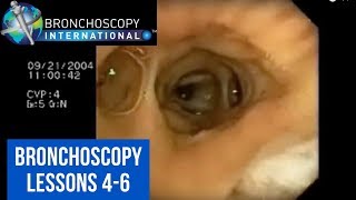 Bronchoscopy Step by Step Details Lessons 46 [upl. by Cock399]