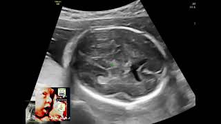 ColpocephalyPartial agenesis corpus callosum fetal ultrasoundDrHaissam ArefDMS fetal ultrasound [upl. by Cruickshank102]