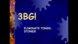 3BG ELIMINATE TONSIL STONES FAST [upl. by Egbert]