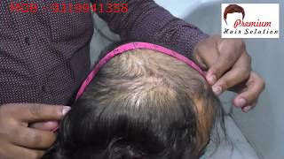 Hair Bonding in Chennai  9319941358  Hair Bonding Clinic in Chennai  PHS [upl. by Ettezel997]