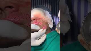 Vitiligo Surgery 👩🏻‍💼 Happy Patient Review amp Story  Skinaa Clinic Viral shorts [upl. by Malcah]