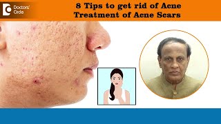 8 Tips to get rid of ACNE SCARS  Best Treatment for Deep Acne Pits  DrD A Satish Doctors Circle [upl. by Dill206]