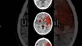 SturgeWeber Syndrome Mnemonic medicalstudent medicaleducation usmlepreparation DiagnosticLens [upl. by Leuqer364]