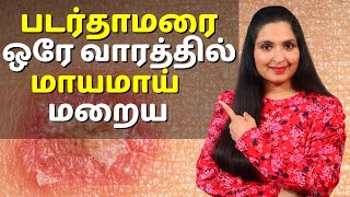 படர்தாமரை மற்றும் தழும்பு ஒரே வாரத்தில் மாயமாய் மறைய  Quickest Way to Get Rid of RINGWORM [upl. by Arenat]