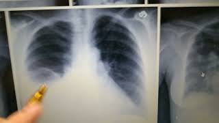 Pulmonology Radiology Pleural Effusion Chest Xray Loss Of Costophrenic Angle [upl. by Stich]