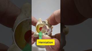 Cervical Disc Herniation C56 Model [upl. by Nnire264]