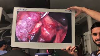 Laparoscopic Right Radical Nephrectomy for Rt Renal mass unedited speed 35 [upl. by Kirad827]