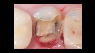 Indirect Posterior Resin Composite Restorations [upl. by Airda935]