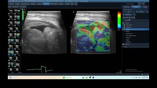 IQ 290 TFAST LUNG MASS ULTRASOUND ICP CPP ECHOPAC ANALYSIS ELASTOGRAPHY 3 [upl. by Auqenwahs]