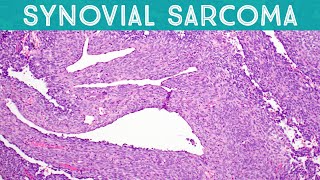 Synovial Sarcoma explained in 5 minutes Soft Tissue Pathology Basics [upl. by Evangeline891]